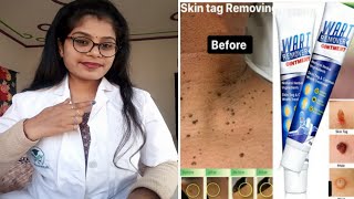 Wart Remover Ointment Wart Remover honest review  Wart Remover Cream benefits uses review in hindi [upl. by Hungarian]