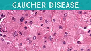 Gaucher disease involving bone lysosomal storage disorder glucocerebrosidase deficiency pathology [upl. by Dnilazor]