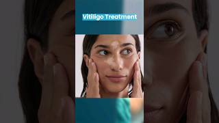 Vitiligo Treatment by Surgery  Dr Gaurav Garg Dermatologist [upl. by Ainattirb516]