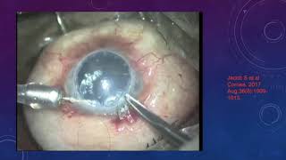 Pre Descemet Membrane Keratoplasty PDEK [upl. by Oivatco]