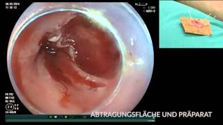 Karzinom im Barrett Ösophagus EMR und RFA [upl. by Akiras701]