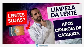 Capsulotomia com YAG laser limpeza da lente após cirurgia de catarata  Dr Gustavo Bonfadini [upl. by Francis211]