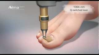 ClearChoice a dual laser approach to onychomycosis from Alma Lasers [upl. by Purvis]