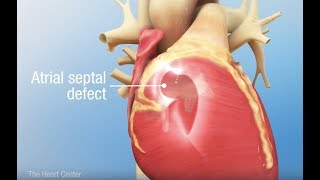 Atrial septal defect  Circulatory System and Disease  NCLEXRN  Khan Academy [upl. by Styles]