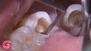 HOW TO Clean Up Severe Occlusal Decay on TOOTH 31 1 of 2 [upl. by Ynna24]