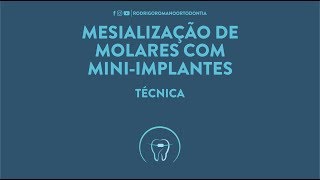 Mesialização de molares com miniimplantes  Técnica [upl. by Jared]