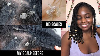 How I cleared Seborrheic Dermatitis amp Healed my scalp NOT SPONSORED  Giveaway [upl. by Nywloc]