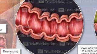 Bowel Perforation [upl. by Niriam]