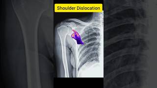 Shoulder Dislocation [upl. by Lais]