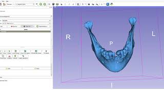 Mandibular osteotomies in orthognathic surgery [upl. by Kara997]