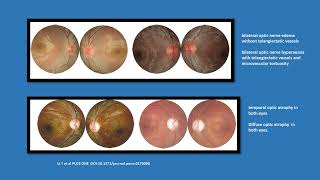 Neurology Quiz 98 Lebers hereditary optic neuropathy LHON [upl. by Eerdna647]