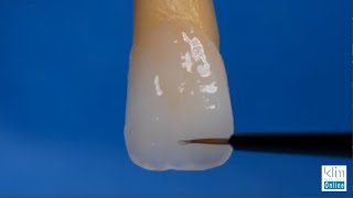 Creating Incisal Edge Effects on Monolithic Veneers and Crown [upl. by Yoj495]