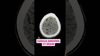 Venous Angioma CT Brain Explained [upl. by Saylor]