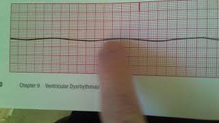 Agonal and Asystole [upl. by Ogawa]