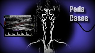 Cases  Vascular  Takayasus Arteritis [upl. by Essa]