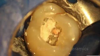 Rootcanals101  What external cervical root resorption looks like [upl. by Nealy598]