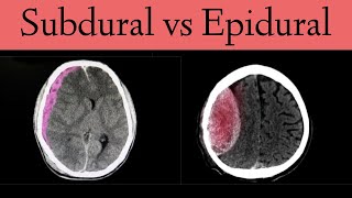 Subdural vs Epidural HematomaHemorrhage CT Scan Findings [upl. by Attenehs]