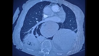 Pneumomediastinum and surgical emphysema due to perforated hiatus hernia [upl. by Lyrak524]