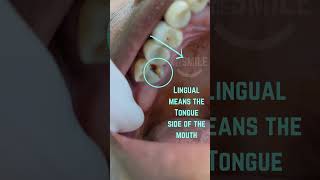 Broken tooth Removed dentist extraction verynicesmiledental [upl. by Petronille]