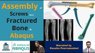 Abaqus Assembly of Screws on a Fractured Bone [upl. by Waylen674]