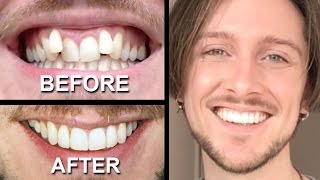 INVISALIGN REVIEW  everything you need to know [upl. by Atikahc286]