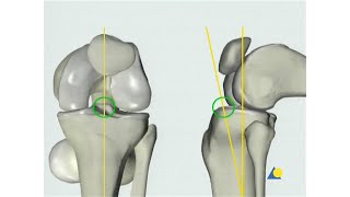 Tibia  Fracture  Intramedullary Nailing with the Expert Tibial Nail Without Reaming [upl. by Maurili]