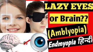 Lazy eye  Amblyopia  Patching  Endmyopia Hindi  कैसे ठीक करे How to treat lazy eye in kids8 [upl. by Sialac569]