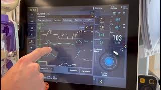 Het berekenen van de occlusie druk en predicted transpulmonaal druk ServoU [upl. by Caputo]