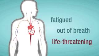 Valve Regurgitation When a Heart Valve Leaks [upl. by Ayahc]