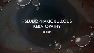 PSEUDOPHAKIC BULLOUS KERATOPATHY [upl. by Lombardy]