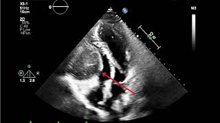 Echocardiogram of Rare Right Ventricular Myxoma [upl. by Maitland]