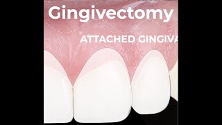 Esthetic Gingival Recontouring after Orthodontic Treatment [upl. by Myrt252]