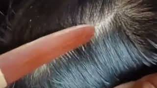 ASMR checking lice and nits and hunting lots of nits👍 part2 [upl. by Yeznil282]