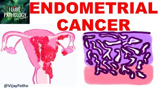 ENDOMETRIAL CARCINOMA Risk factors Etiopathogenesis Morphology amp Clinical features [upl. by Fabyola]