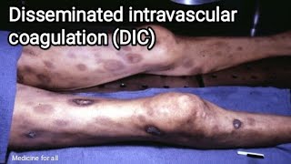 Disseminated intravascular coagulation  DIC  causes symptoms pathologydiagnosis treatment [upl. by Halima422]