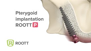 Pterygoid implant ROOTT P [upl. by Thora405]