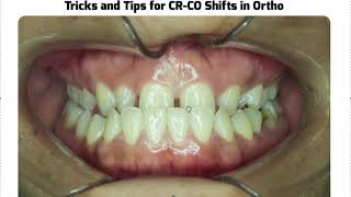 How to Deal with Anterior Crossbite Cases with CrCo Shifts [upl. by Marie-Ann]