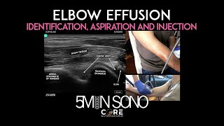 Elbow Effusion  Identification Aspiration and Injection [upl. by Auqkinahs]