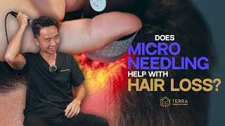 Is Microneedling The Cure For Hair Loss [upl. by Cleve]