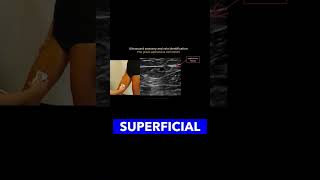 Identifying the Great Saphenous Vein vascularultrasound healthcareexcellence MedicalEducation [upl. by Salahcin]