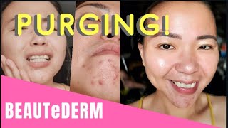 Beautederm Purging  side effect after one month  honest review [upl. by Ekard]