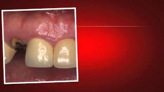 Implant Case 7  Dr Tarun Agarwal Part 1 Case introduction [upl. by Aronoel]