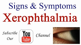 Signs and Symptoms of Xerophthalmia [upl. by Weig]