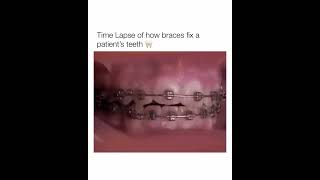 Time Lapse of how braces fix a patients teeth shorts [upl. by Tasia]