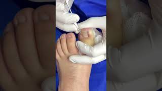 MATRICECTOMIA QUÍMICA ingrowntoenailsurgery satisfying [upl. by Onileva]