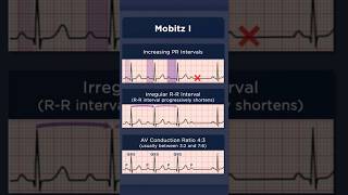 Type I Second Degree Atrioventricular Block ECG AV conduction ratio [upl. by Eenwat704]