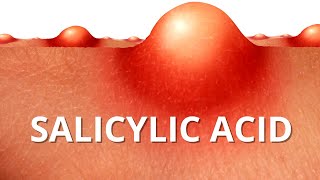 Heres WHY Salicylic Acid is Best For ACNE [upl. by Adnara240]