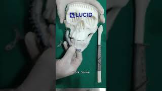 Guided Mandible Resection amp Reconstruction using Fibula Free Flap amp CustomMade Titanium Implant [upl. by Johst]