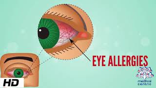 Eye Allergy Causes Signs and Symptoms Diagnosis and Treatment [upl. by Aynotak]