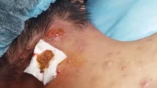 Extract Acne in Nape  HHV Clinic [upl. by Zebapda27]